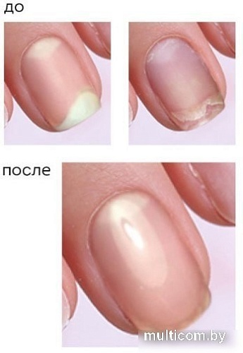 Лак Emi Антифунгал профилактика грибковых заболеваний