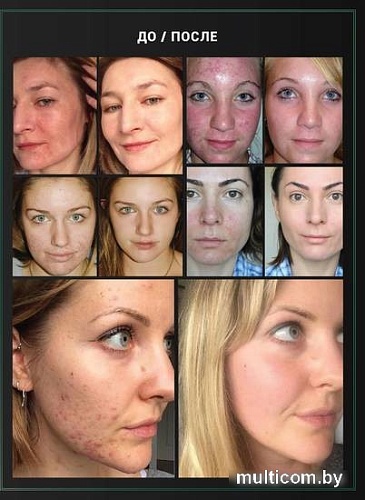 LifeCode Anti acne 30 мл